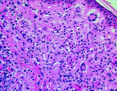 Figure 2: Follicular Dendritic Cell Sarcoma with prominent whirling.