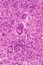 Figure 6: Langerhans cell histiocytosis with prominent eosinophils.