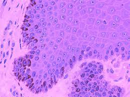 Figure 8: Juvenile Xanthogranuloma with giant cells and granuloma formation.