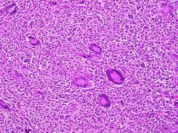 Figure 9: Juvenile Xanthogranuloma with giant cells.