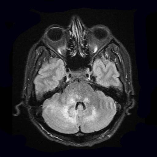 Figure 1: Hiperintens lesions at axial “flair” brain MR images.