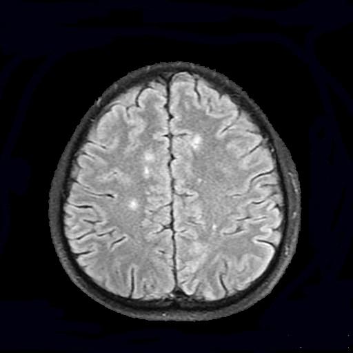 Figure 2: Hiperintens lesions at axial “flair” brain MR images.