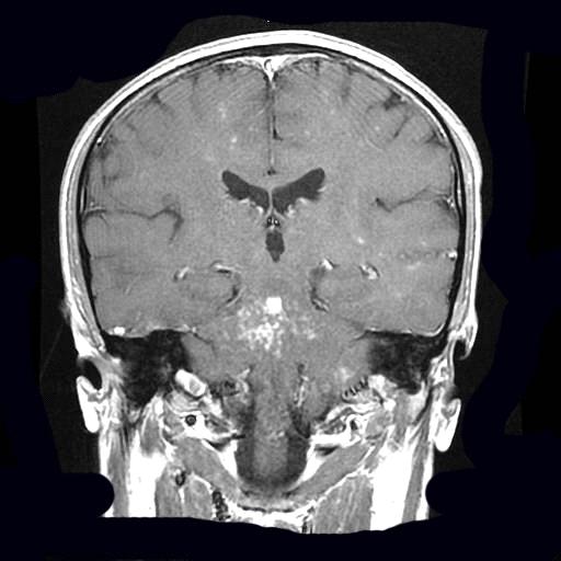 Figure 3: Typical contrast agent uptake in pons, at T1W coronal images.