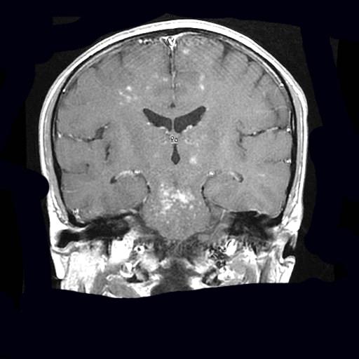 Figure 5: Typical contrast agent uptake in pons and cerebellum (Axial MR images).
