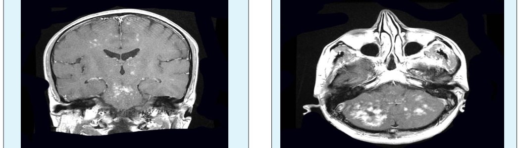 Figure 7: Typical contrast agent uptake in pons and cerebellum at T1W axial images.
