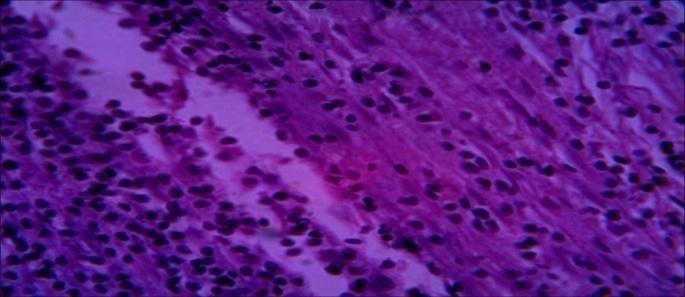 Figure 11: Section of specimen (5) lung tissue. Diagnosis: pyogenic cavity Microscopy: section show lung tissue with wall composed of inflammatory granulation tissue with suppuration. No hydatid cyst.