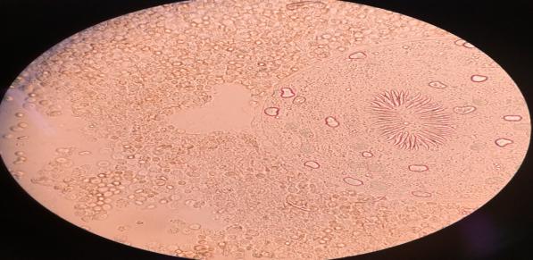 Figure 3: Wet mount observation: Significant mass of ovoid protoscoleces can be seen, with their normal structures and calcareous corpuscles intact.