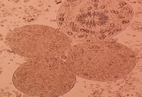 Figure 4: Wet mount observation: Significant mass of ovoid protoscoleces can be seen, with their normal structures and calcareous corpuscles intact.