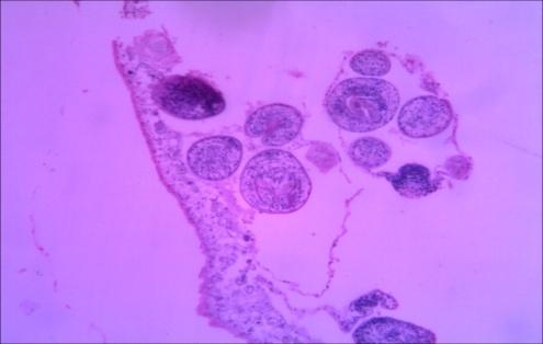 Figure 7: Section of specimen (1) liver tissue. Diagnosis: Hydatid cyst Microscopy: section of specimens show cyst wall composed of fibrous laminated layer with inner germinal layer with broad capsule and scolices surrounded by fibrous capsule.