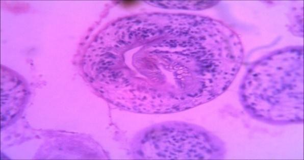Figure 8: Section of specimen (2) lung tissue. Diagnosis: Hydatid cyst Microscopy: section of specimens show cyst wall composed of fibrous laminated layer with inner germinal layer with broad capsule and scolices surrounded by fibrous capsule Specimen (3) Lung tissue