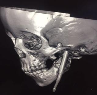 Figure 10: Removal of ankylosis mass, inverted L- osteotomy and distractor installation.