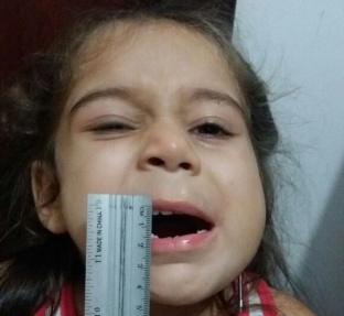 Figure 11: Postoperative after total distraction of 1st surgery.