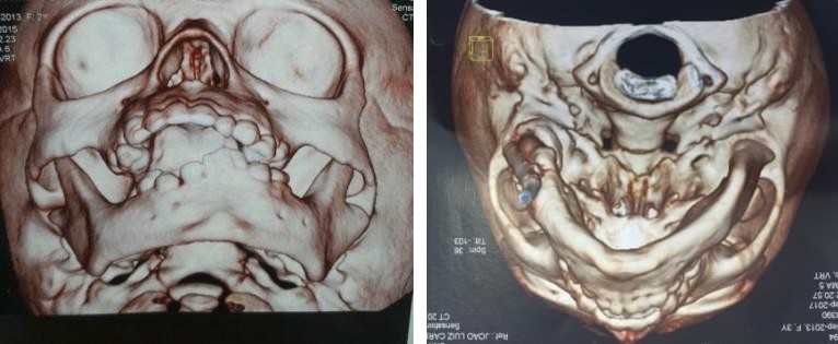 Figure 13: Mouth opening after 3rd surgery of 15 mm and after removed distractor (10mm).