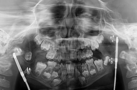 Figure 4: Resection of ATM ankylosis and exposure of the gonial angle, Osteotomy of inverted L-mandibular and Installation of the linear osteogenic distractor.
