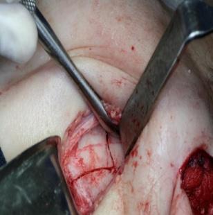 Figure 5: Postoperative buccal opening Immediate postoperative.
