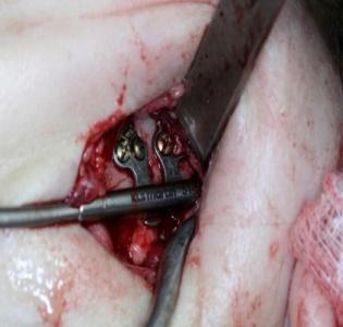 Figure 7: Preoperative aspect and final appearance.