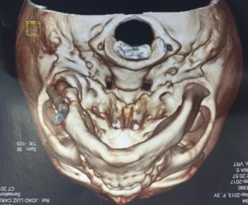 Figure 9: Initial tomography.
