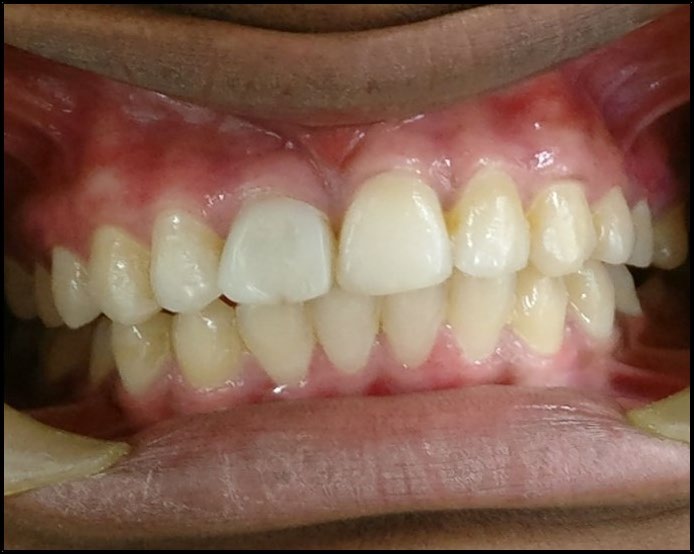 Figure 3: Completion of gingival depigmentation in mandibular arch.