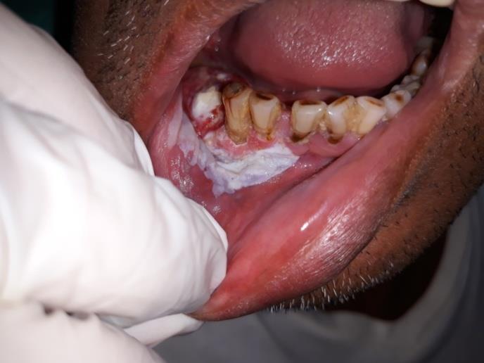Figure 2: Intraoral image showing well define homogenous white patch in buccal vestibule extending to buccal mucosa.
