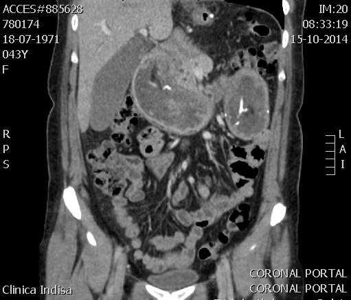 Figure 1: CT reports, Gastroduodenal invagination up to the level of jejuno-jejunostomy that causes extrinsic compression of the invaginated content at the level of the duodenal papilla and the head of the pancreas.