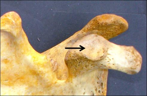 Figure 1: Image showing presence of definite articular facet on coracoid process (arrow).