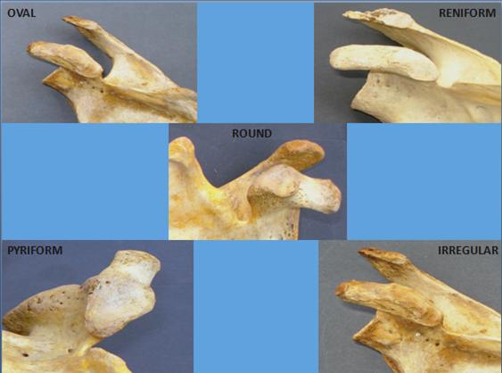 Figure 4: Image showing types of surface architecture of articular facet.