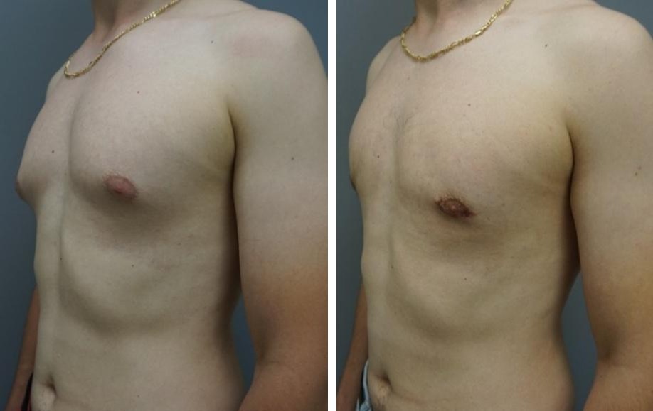 Figure 2: 32-year old patient with Simon’s type I-II a gynecomastia with asymmetry due to anabolic steroids use.
