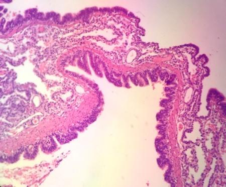 Figure 9: Gross appearance of the pulmonary lobe shows multiple varying-sized cystic formations (larger then 2 cm) outlined by thin walls with honeycomb appearance (arrows).
