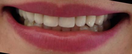 Figure 6: Extra-oral view after adhesive cementation.