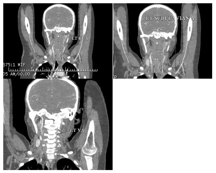 Figure 2: Shows diffuse circumferential wall thickening with adjacent fat inflammation causing severe luminal narrowing of left common carotid, subclavian and vertebral artery respectively.