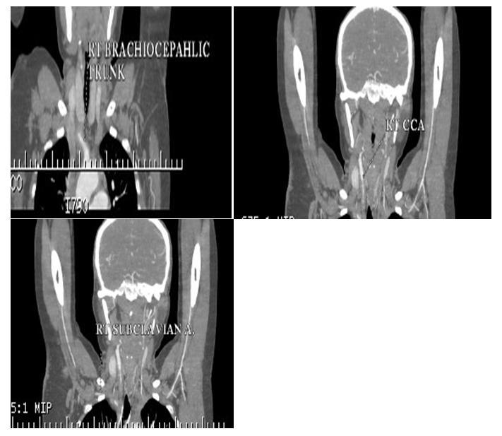 Figure 3: Shows diffuse circumferential wall thickening with adjacent fat inflammation causing severe luminal narrowing of right brachiocephalic trunk, common carotid and subclavian artery respectively.