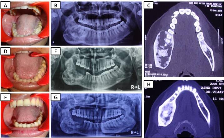 Figure 1: (A) Pre-op intraoral photograph shows vestibular obliteration. (B) Pre-op orthopantomogram shows huge multilocular lesion situated on right mandibular corpus, adjacent ramus and coronoid process. (C) Pre-op axial CT image shows expansile lytic lesion involving the right mandibular posterior region. (D) 4 months post-op intraoral photograph shows completed soft tissue wound healing. (E) 4 months post-op orthopantomogram image shows bone healing is going on and no sign of recurrence. (F) 15 months post-op intraoral photograph shows no sign of any recurrence. (G) 15 months post-op orthopantomogram image shows good bone healing and no sign of recurrence. (H) 15 months Post-op axial CT image shows reduced cortical expansion, uneventful bone regeneration and healing with no sign of recurrence. Incisional histopathologic examination revealed the presence of hypercellular connective tissue stroma, consisting of numerous mature and proliferating fibroblasts with few collagen fiber bundles ramifying in different direction. Few areas having dense collagen fiber bundle and newly formed osteoid along with presence of oval shape giant cells in moderate number. Numerous endothelial lined blood capillaries with areas of hemorrhage are also present with mild chronic inflammatory cell response (Figure 2). Overall clinical, radio-graphical and histopathological features are suggestive of aggressive central giant cell granuloma. Surgery was performed by using a set of standard Copyright© Vijay Kumar