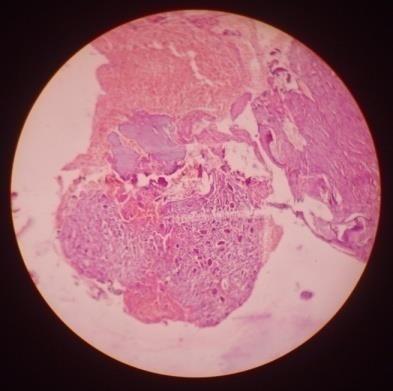 Figure 2: 10X H & E stained section reveals connective tissue stroma that consisting of (a) Fibroblasts & Collagen fiber bundles; (b) Osteoid areas; (c) Multiple giant cells; (d) Hemorrhagic areas. During first four initial clinical follow-up of wound evaluations, slight bleeding and pain was noted, but resolved after repeated wound packing with iodoform gauze. Clinically intraoral complete soft tissue healing was achieved at about 4 months (Figure 1D) and improved facial symmetry with no sign of any soft tissue recurrence noted during 15 months (Figure 1F) follow-up. Panoramic radiographs were taken at 4 months and 15 months that revealed bone regeneration was uneventful (Figure1E&G) and 15 months postoperative axial CT reveals well cortical thickening, resolution of cortical expansion, uneventful bone regeneration and healing (Figure 1H). Few sclerotic areas are also seen but no evidence of abnormal enhancement seen after IV contrast and extra osseous soft tissue component. In addition, there was Vijay Kumar. Postoperative evaluation of Conservative Surgical Approach on Central Giant Cell Granuloma of the Mandible: A case report.J Dental Sci 2016, 1(2): 000114.