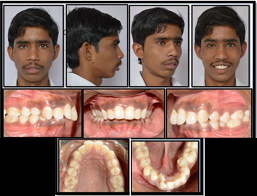Figure 1: Pre-treatment extraoral and intraoral photographs.