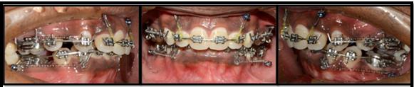 Figure 3: Mini implant assisted intrusion in upper anterior segment and retraction in the lower segment.