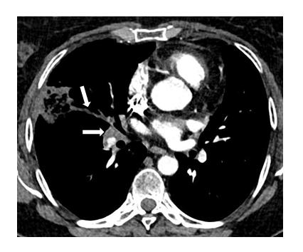 Figure 1: Multiple segmental acute pulmonary embolism on mediastinal window of thoracic angio-CT (white arrows).