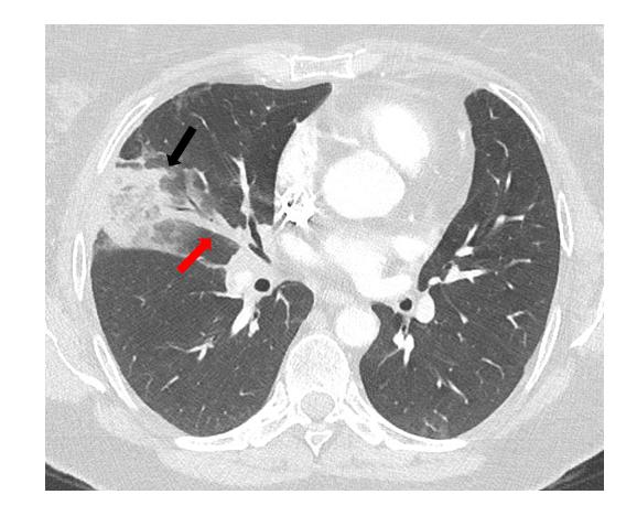 Figure 2: The same cross section of thoracic angio-CT in parenchymal window, showing peripheral round pulmonary consolidation bordered by ground glass (halo sign) in the middle lobe (black arrow) and thickened vessel leading to the apex of the opacity (vascular sign) (red arrow), confirming pulmonary infarction.