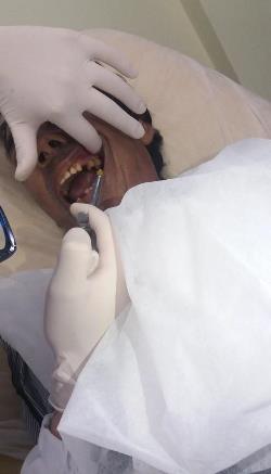 Figure 2: Dental anesthesia for oral surgery.