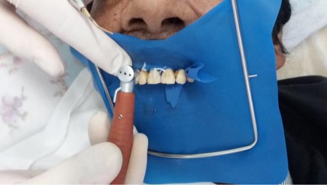 Figure 3: Dental restoration performed in side of HD advice with mobile dental equipment.