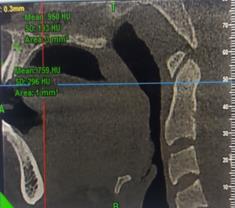 Figure 2: Extremely thin labial cortical plate as seen on CBCT at baseline.