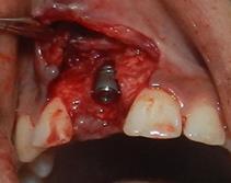 Figure 4: Atraumatic extraction of tooth with periotome.