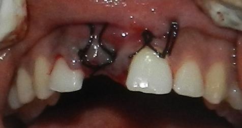 Figure 7: Complete coverage of dental implant with labial cortical plate of 1.8 mm thickness and bone density of 1021 HU as seen on CBCT.
