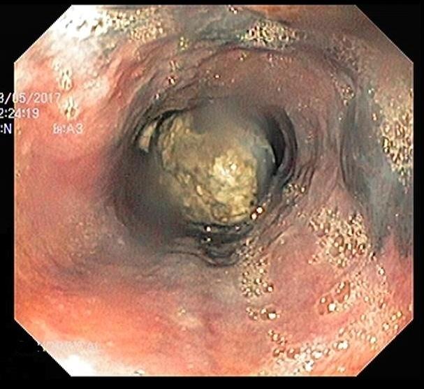 Figure 3: Upper Gastrointestinal Endoscopic view of Melanotic growth in esophagus.