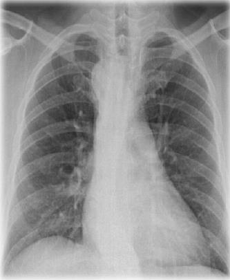 Figure 1: Chest X-ray PA view showing absent left aortic knuckle and mediastinal widening.