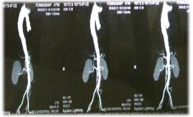 Figure 3: CT aortogram showing Type II right aortic arch with aneurysmal dilatation at the anomalous origin of left subclavian artery.