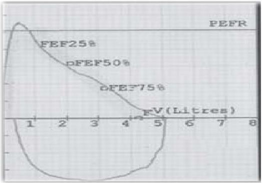 Figure 4: Pulmonary function test.