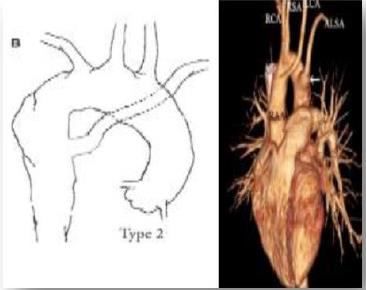 Figure 7: Type 2 Right sided aortic arch with aberrant subclavian artery.