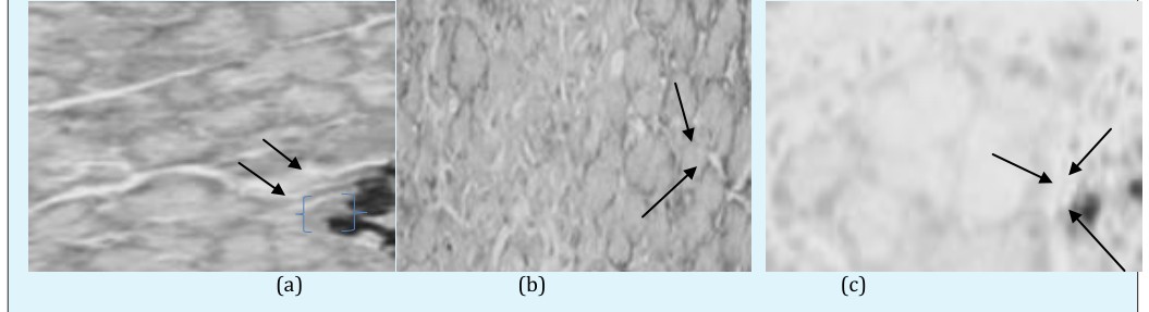 Figure 1: (b) Histopathological observation of pancreatic H-cell as indicated by the black arrow in the normal rat, while (a). Streptozotocin (STZ) induced pancreatic H-cell and (c). Diabetic rat + Barringtonia racemosa Dichloromethane extract with a dose of 400mg/kg/ bwt.