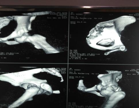Figure 2: Radiography of the disocated hip.