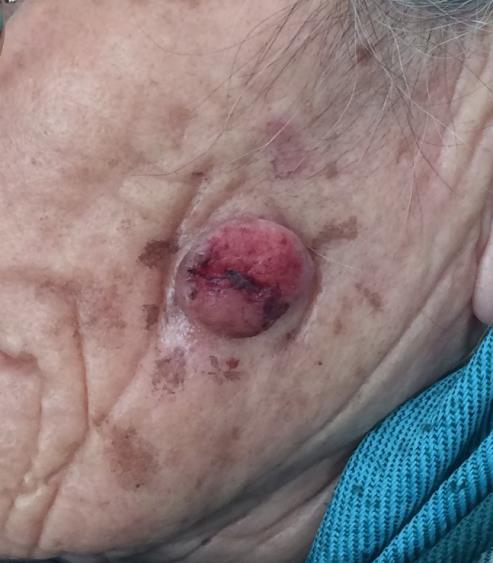 Figure 1: Clinical image showing an erythematous and well-defined rounded tumor, with smooth surface, measuring about 2.5 cm, on the left cheek, surrounded by multiple actinic keratosis.